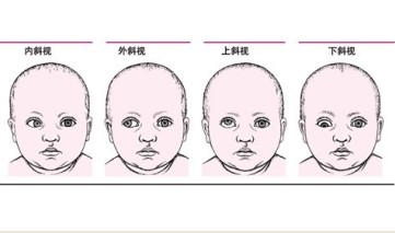 小儿斜视治疗
