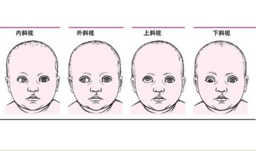 属眼外肌疾病,可分为共斜视和麻痹性斜视两大类.